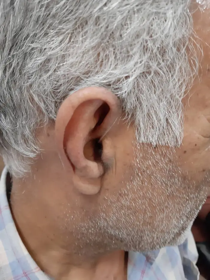 تجویز سمعک Design RITE اتیکن برای مراجع 70 ساله-کلینیک سمعک اقدسیه