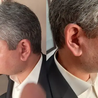 تجویز سمعک استایلتو 5x رنگ مشکی نقره ای در یک فرد ۴۵ ساله