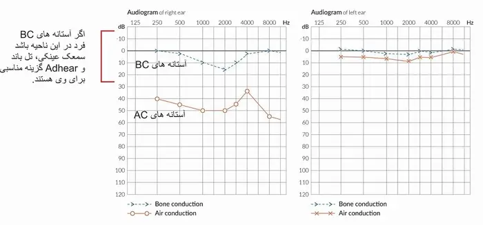 سمعک ADHEAR برای چه افرادی مناسب است؟