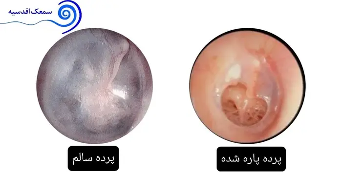 پاره‌گی پرده گوش