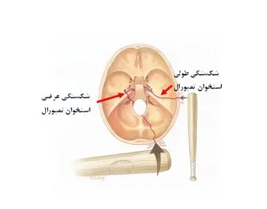 کم شنوایی ناشی از ضربه به سر