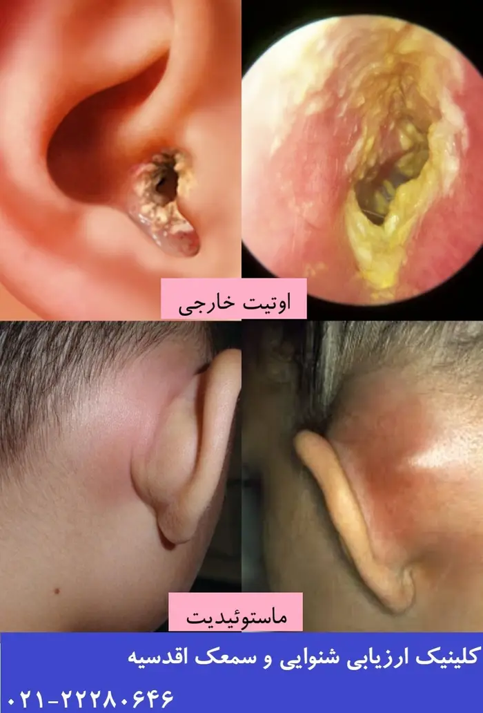 اوتیت خارجی