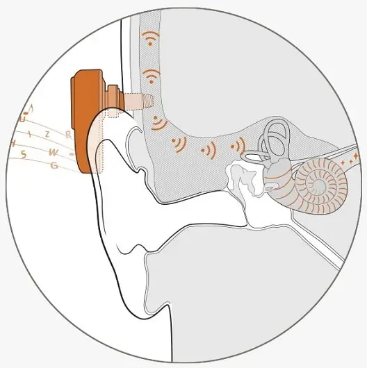 انواع سمعک‌های استخوانی کاشتنی