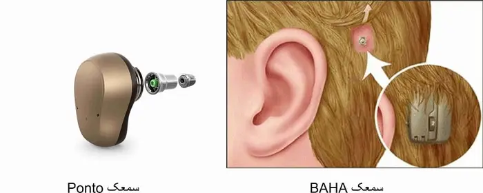 Ponto BAHA hearing aid 