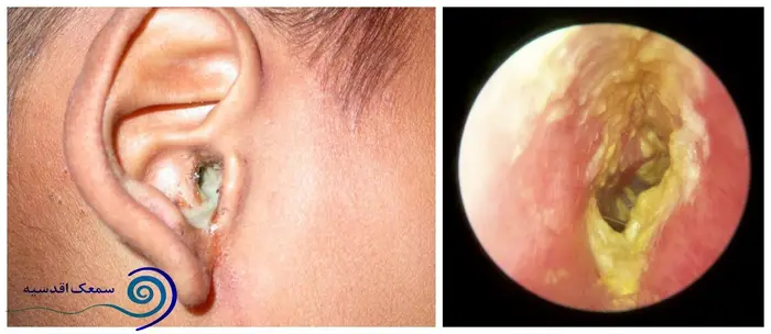 عفونت گوش خارجی