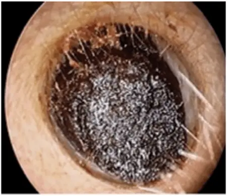 تجمع جرم گوش از عوامل کیپی گوش