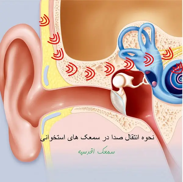 سمعک استخوانی چیست