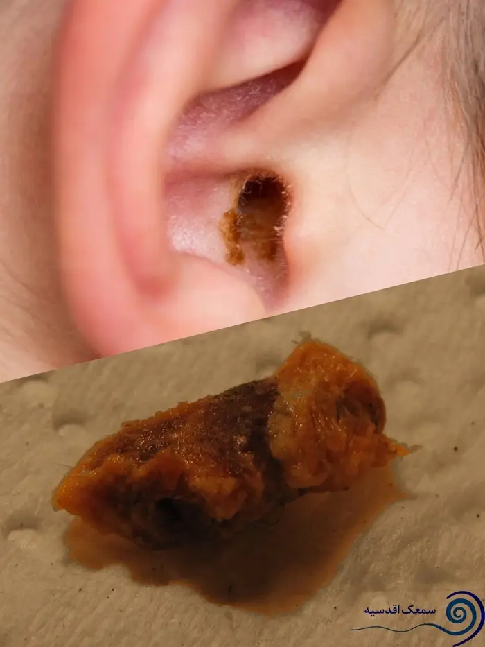 جرم گوش موم