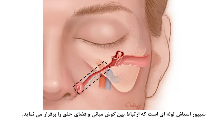 شیپور استاش و احساس گرفتگی گوش 
