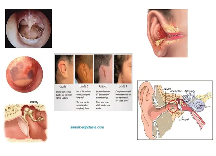 دلایل ایجاد کم شنوایی کانداکتیو 