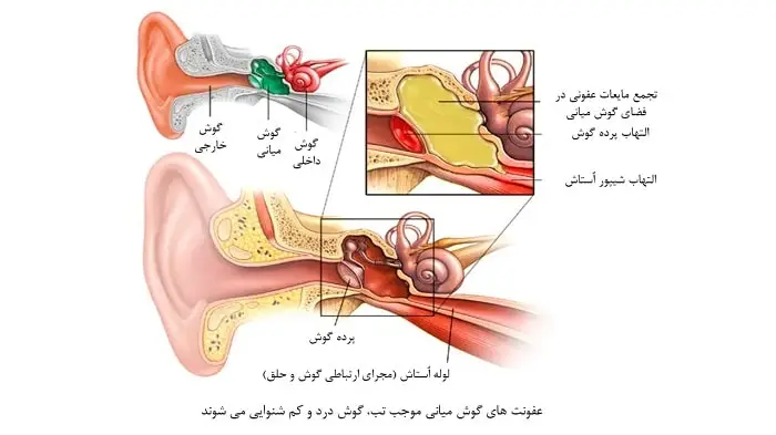 عفونت گوش میانی