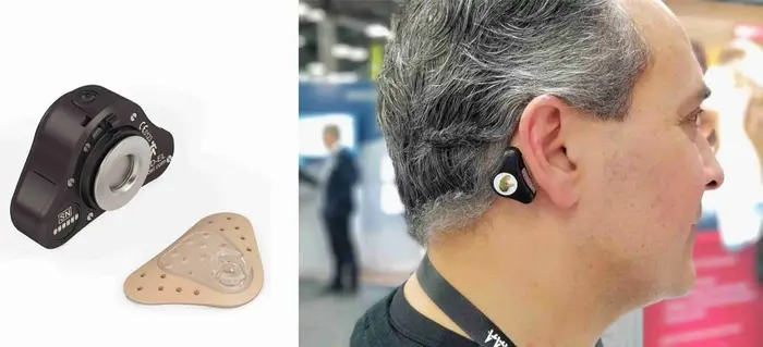 سمعک ADHEAR | کاشت سمعک استخوانی