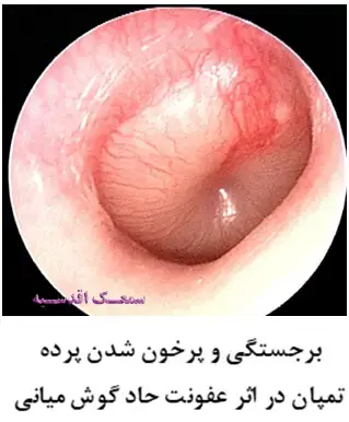Acute Otitis Media