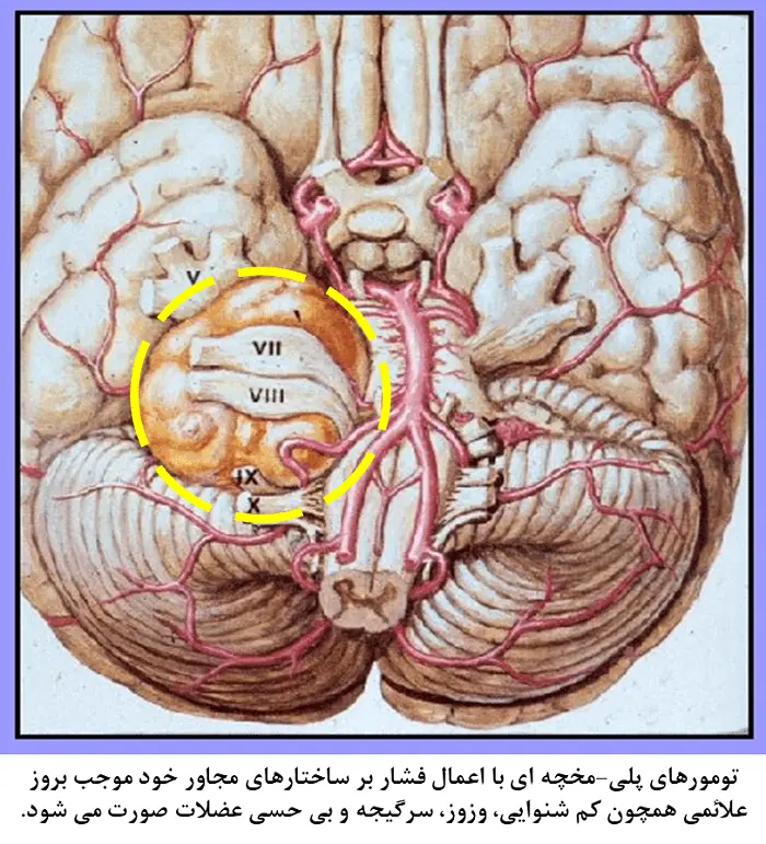 تومورهای زاویه پلی-مخچه¬ای
