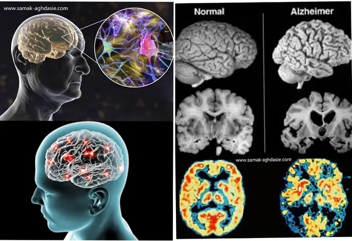 فعالیت بیش از حد مغز