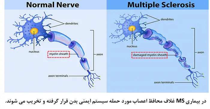 • بیماری ام اس(Multiple Sclerosis