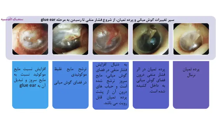 Otitis Media With Effusion