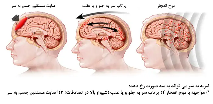 ضربه (تروما) سر