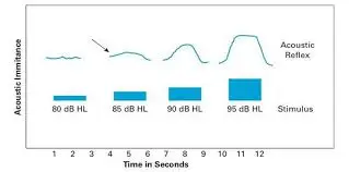 آستانه رفلکس اکوستیک
