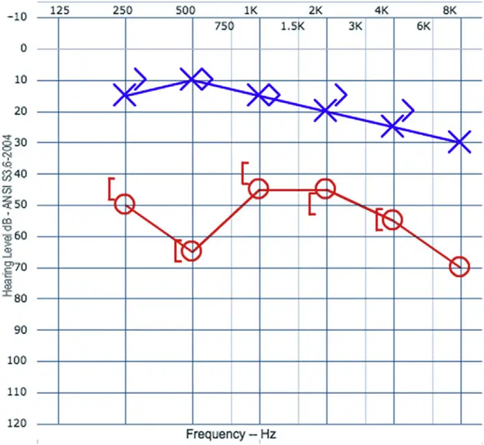 ادیوگرام- آستانه های انتقال هوایی و استخوانی گوش راست و چپ