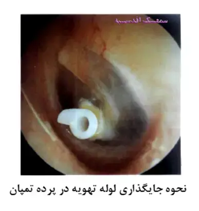 نحوه جایگذاری لوله تهویه در پرده تمپان