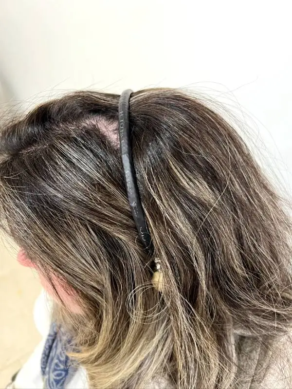 تجویز سمعک استخوانی تلی در یک فرد ۲۷ ساله با مشکل تشکیل نشدن مادرزادی کانال گوش