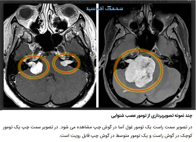 چند نمونه تصویربرداری از تومور عصب شنوایی