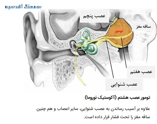 تومور عصب هشتم