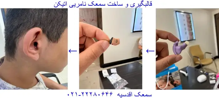 قالب‌گیری و ساخت سمعک نامرئی اتیکن در کلینیک سمعک اقدسیه
