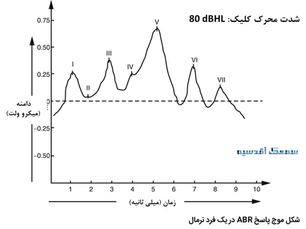 شکل موج پاسخ abr در یک فرد نرمال