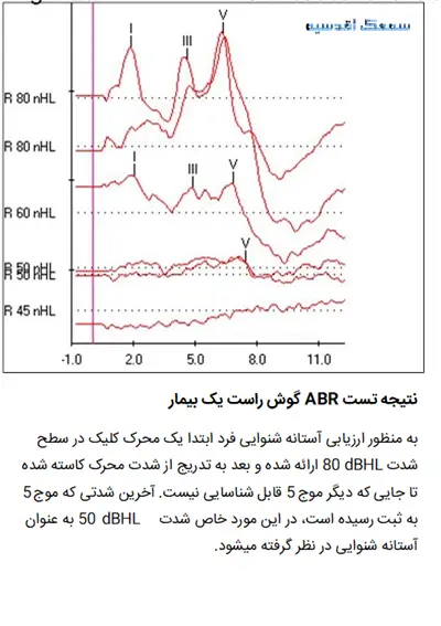 نتیجه تست ABR گوش راست یک بیمار