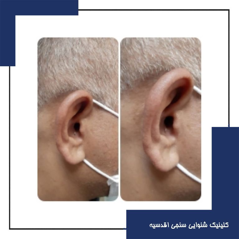 تجویز سمعک OPN 1 اتیکن (مدل داخل گوشی) برای مراجع 55 ساله مبتلا به کم شنوایی شدید در گوش چپ و کم شنوایی متوسط در گوش راست