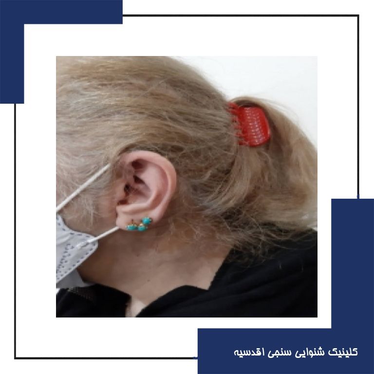 تجویز سمعک OPN 3 در یک فرد 55 ساله با کم شنوایی متوسط تا شدید