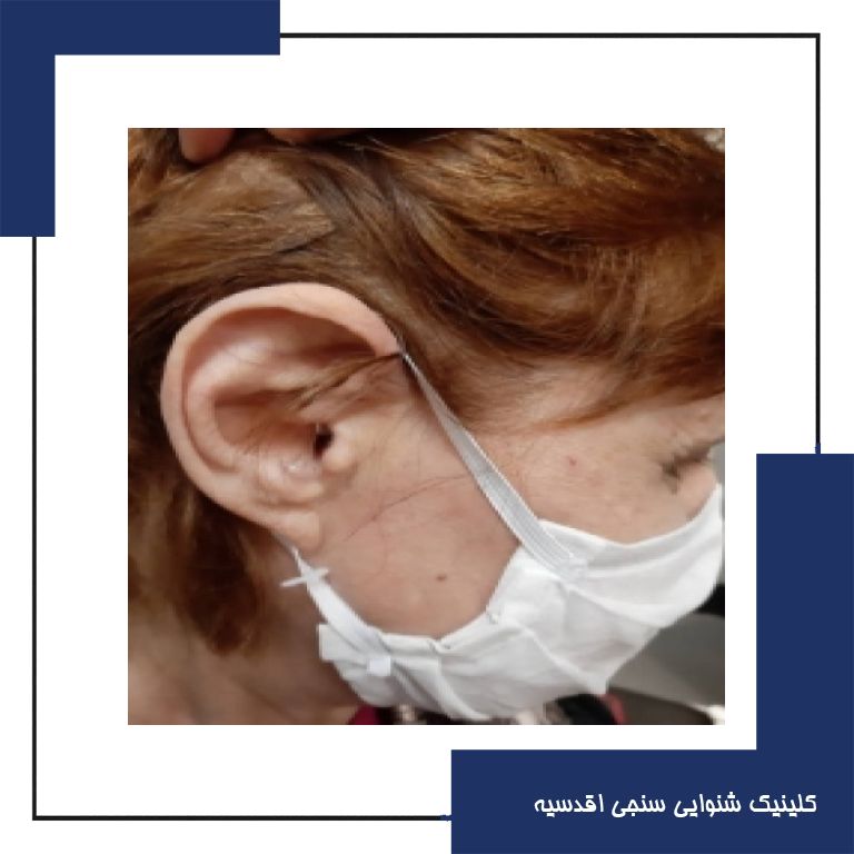 تجویز سمعک opn 1 در یک فرد ۶۵ ساله با کم شنوایی متوسط در هردوگوش