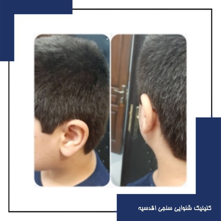 تجویز سمعک RIC اتیکن برای مراجع 11 ساله مبتلا به کم شنوایی متوسط دوطرفه