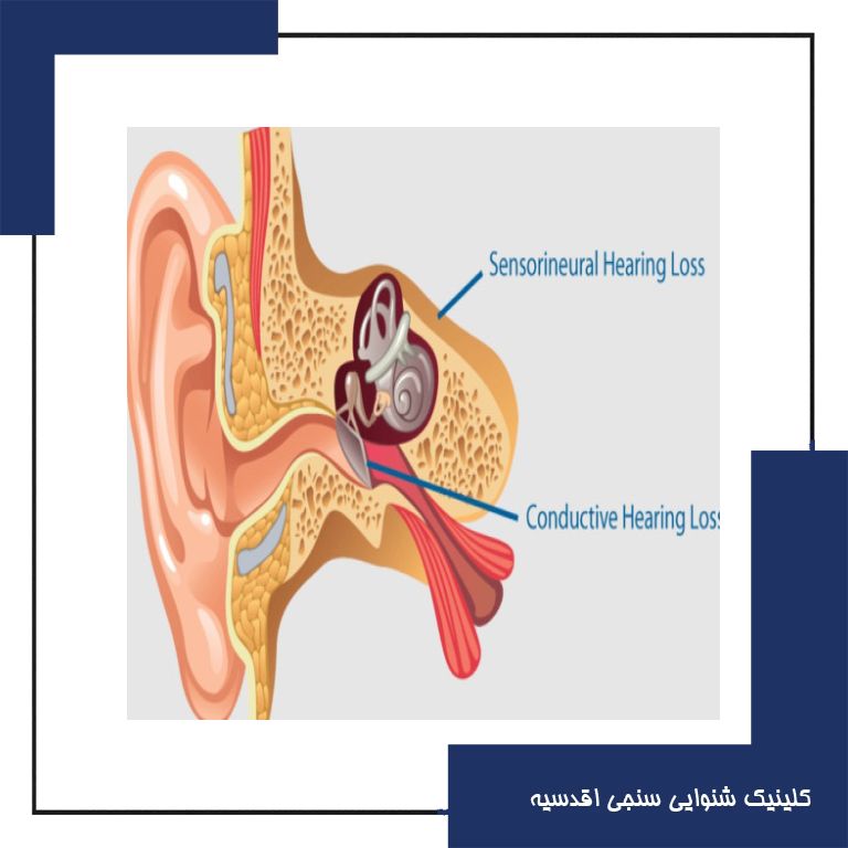 تب انواع کم شنوایی