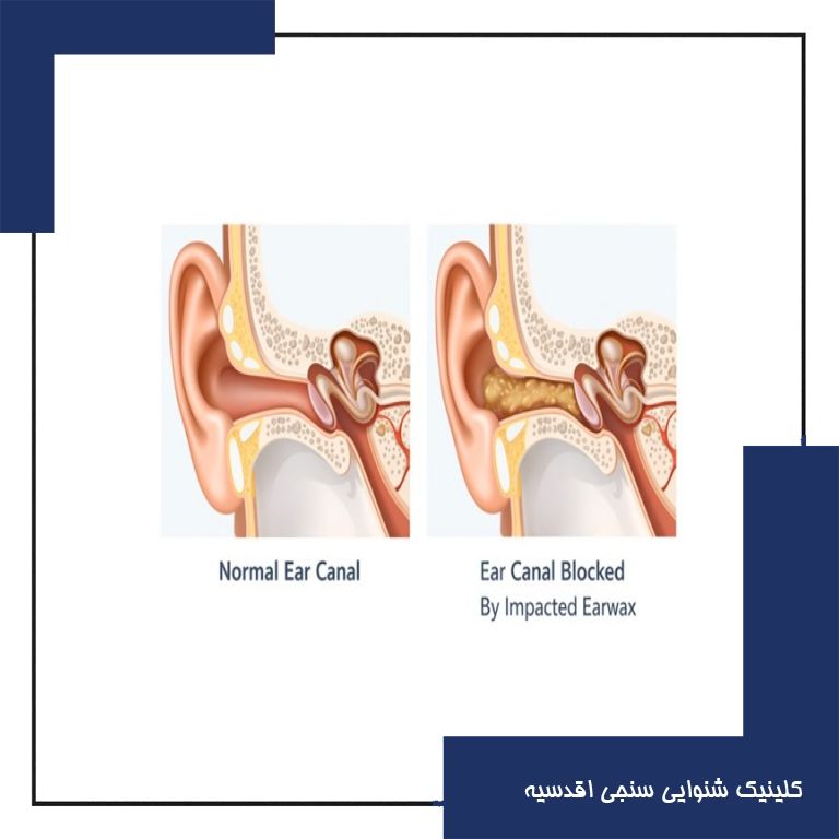 آیا جرم گوش باعث کاهش شنوایی میشود؟