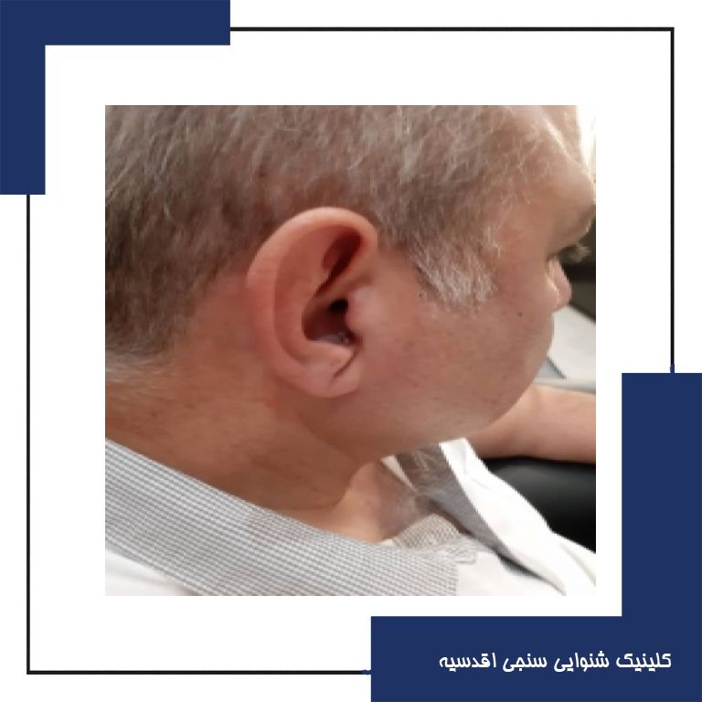 تجویز سمعک 5 nx زیمنس (مدل Silk) برای مراجع مبتلا به کم شنوایی متوسط دوطرفه در فرکانس های بالا