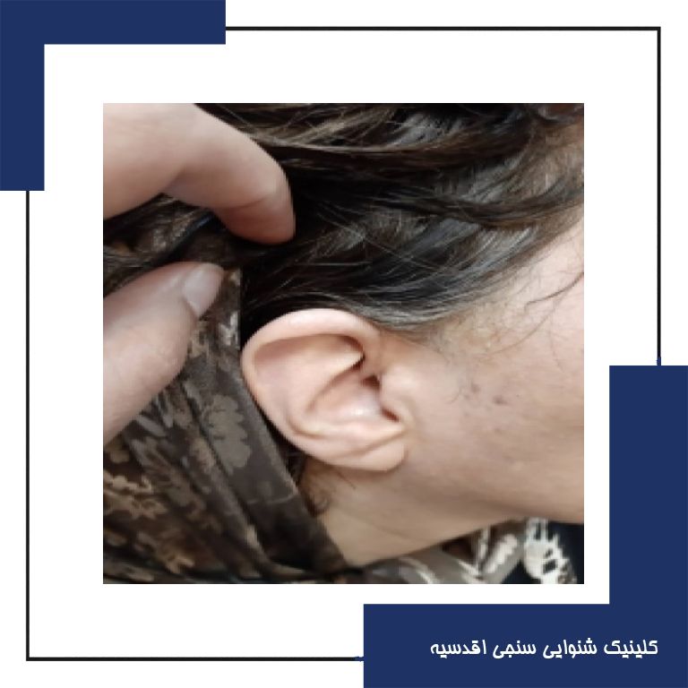 تجویز سمعک Px 2 سیگنیا (مدل RIC) برای مراجع 49 ساله مبتلا به کم شنوایی عمیق در گوش چپ و کم شنوایی متوسط در گوش راست