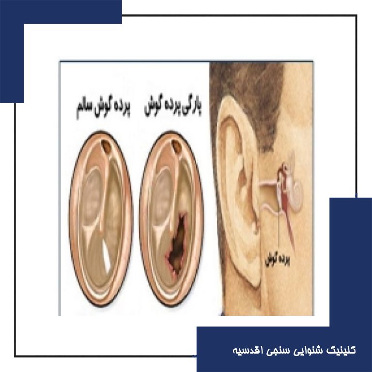 پارگی پرده گوش