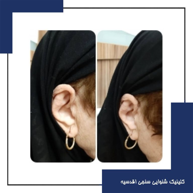 تجویز سمعک Evoke 220 ویدکس (مدل RIC) برای مراجع 70 ساله مبتلا به کم شنوایی متوسط دوطرفه