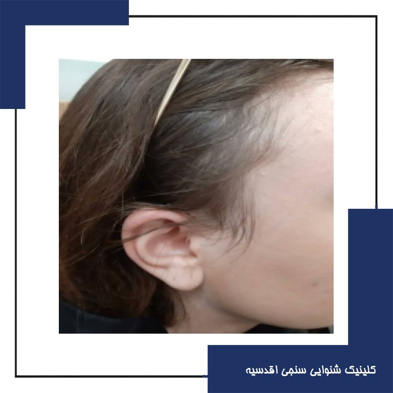 تجویز سمعک pure 3nx زیمنس (مدل RIC) برای مراجع 22 ساله مبتلا به کم شنوایی متوسط دوطرفه