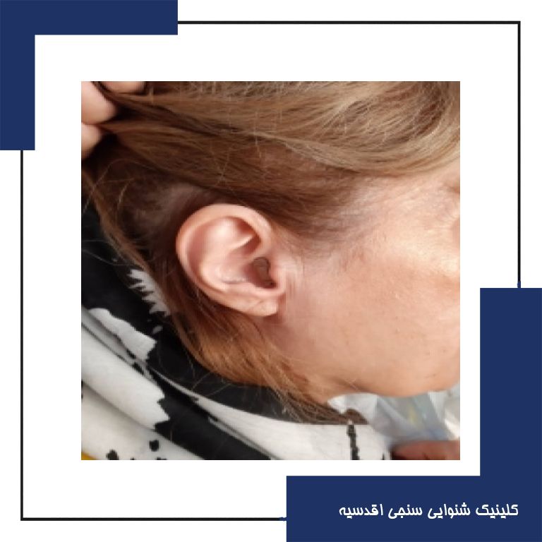 تجویز سمعک داخل گوشی زیمنس در یک فرد ۶۵ ساله با کم شنوایی متوسط تا شدید