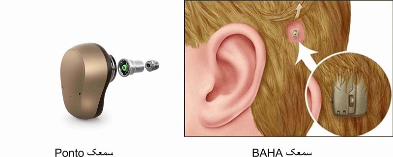 Ponto BAHA hearing aid 