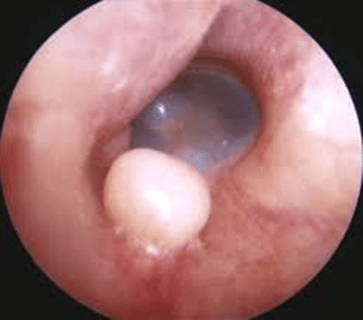 عفونت گوش خارجی (گوش شناگر) از عوامل کیپی گوش