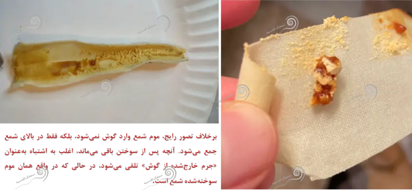 عکس انتهای کار با شمع گوش کلینیک سمعک اقدسیه
