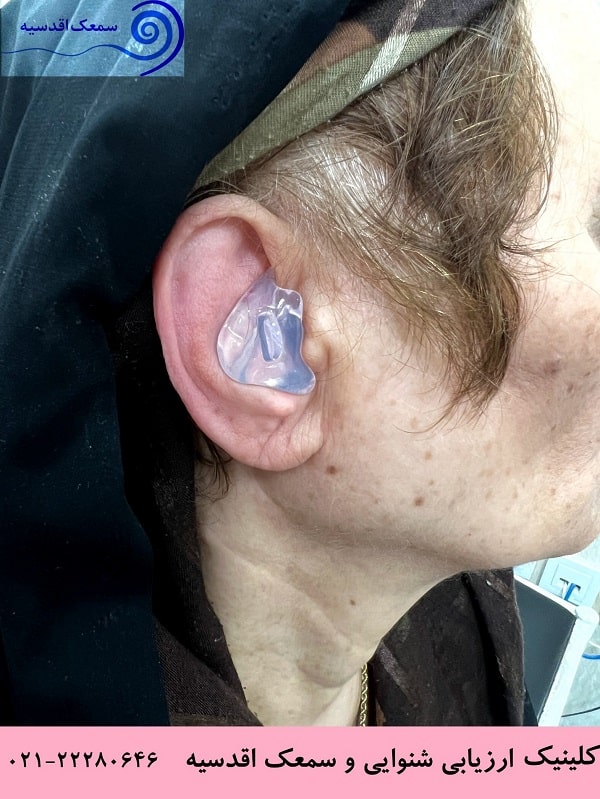 نمونه ای از تجویز قالب گوش در کلینیک ارزیابی شنوایی اقدسیه 