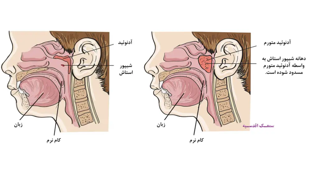 تاثیر التهاب لوزه ها بر گوش