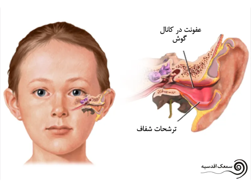 عفونت در کانال گوش