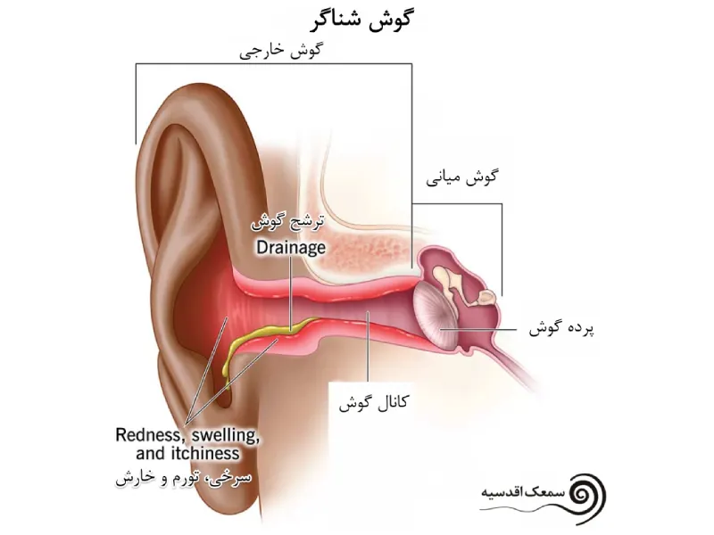 بیماری گوش شناگر چیست؟